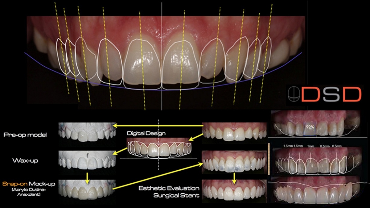 Smile Makeover Design at Mona Vale Dental